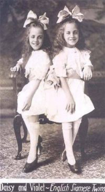 young conjoined twins Violet and Daisy Hilton